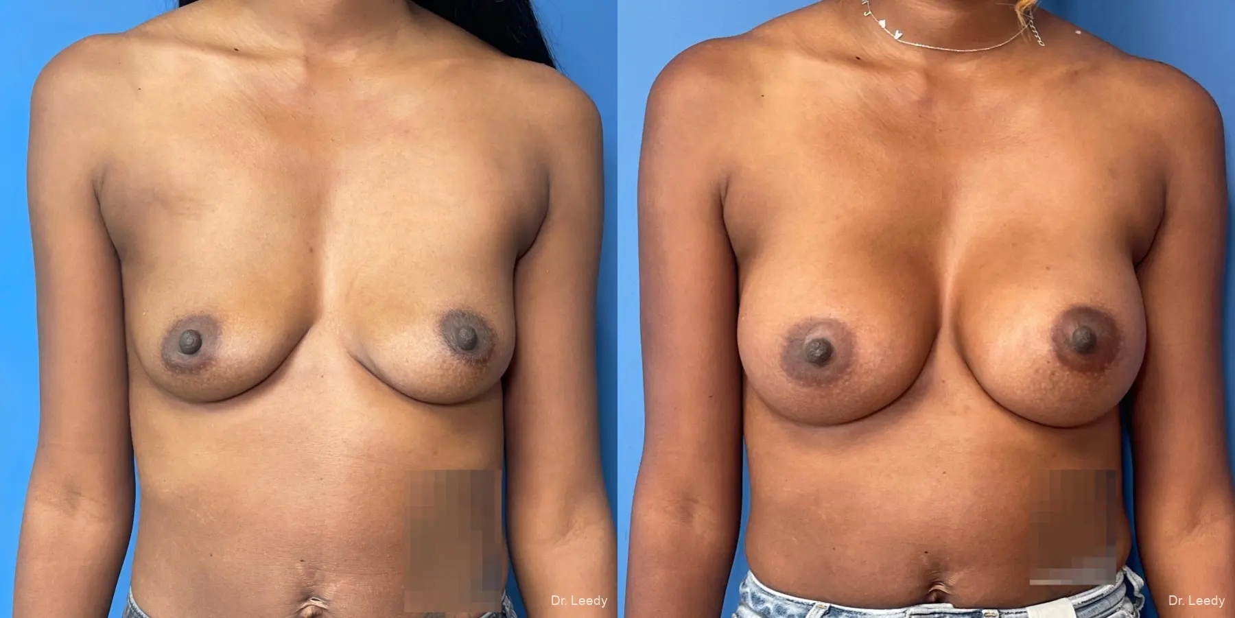 Breast Augmentation: Patient 16 - Before and After  