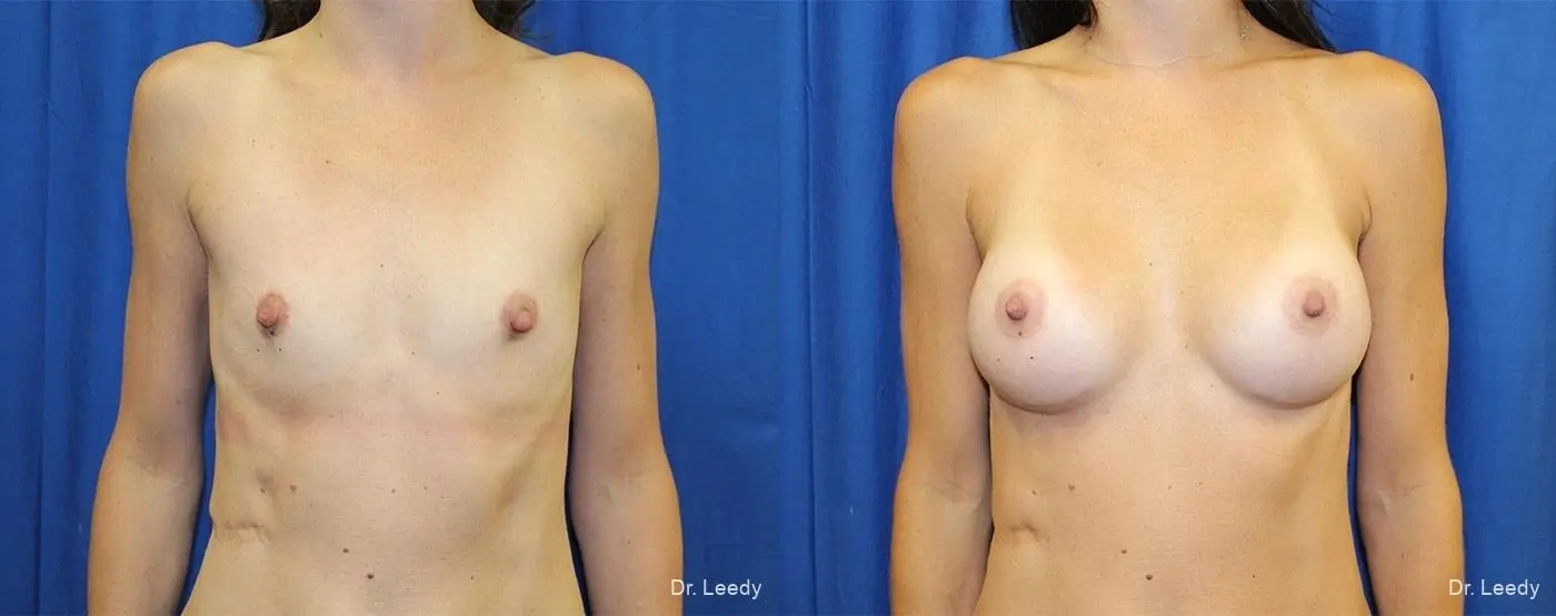 Breast Augmentation: Patient 2 - Before and After  