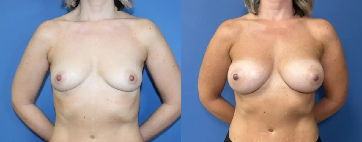 Breast Augmentation: Patient 5 - Before and After  