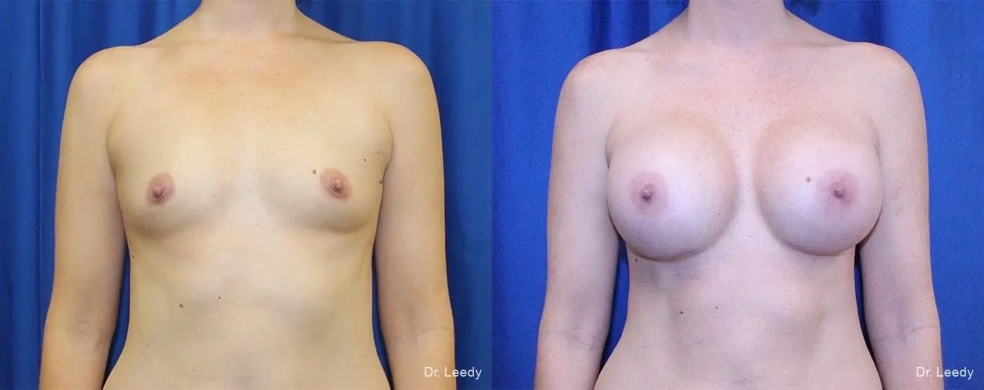 Breast Augmentation: Patient 11 - Before and After  