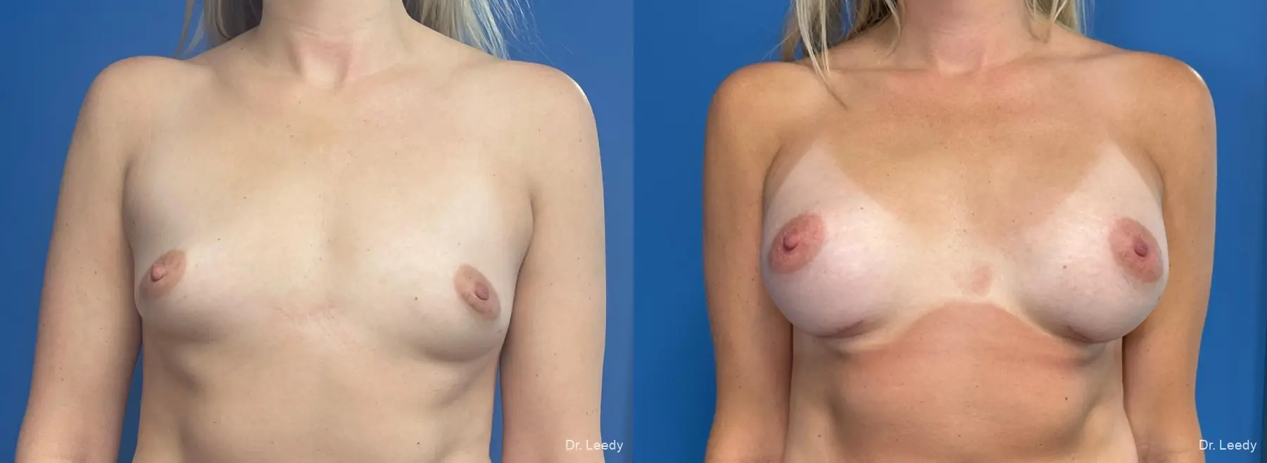 Breast Augmentation: Patient 23 - Before and After  