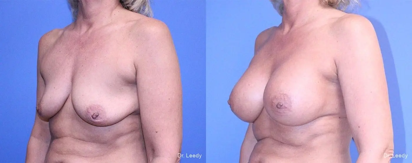 Breast Augmentation: Patient 8 - Before and After 4
