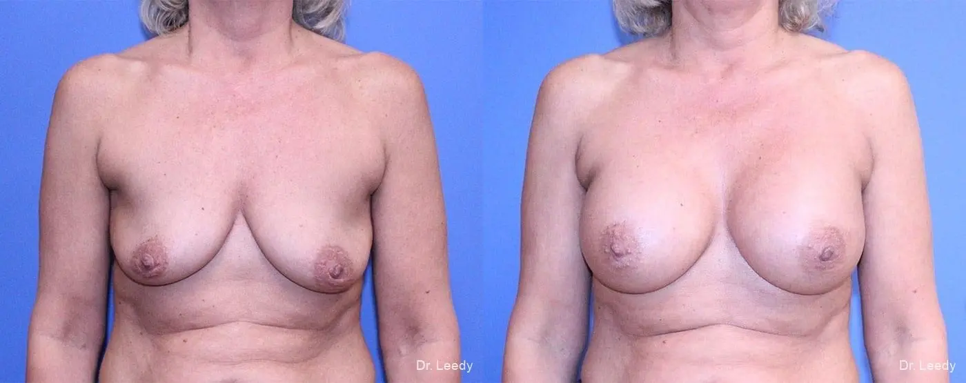 Breast Augmentation: Patient 8 - Before and After 1