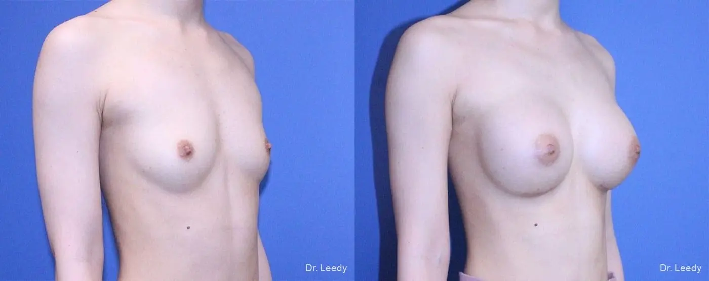 Breast Augmentation: Patient 4 - Before and After 2