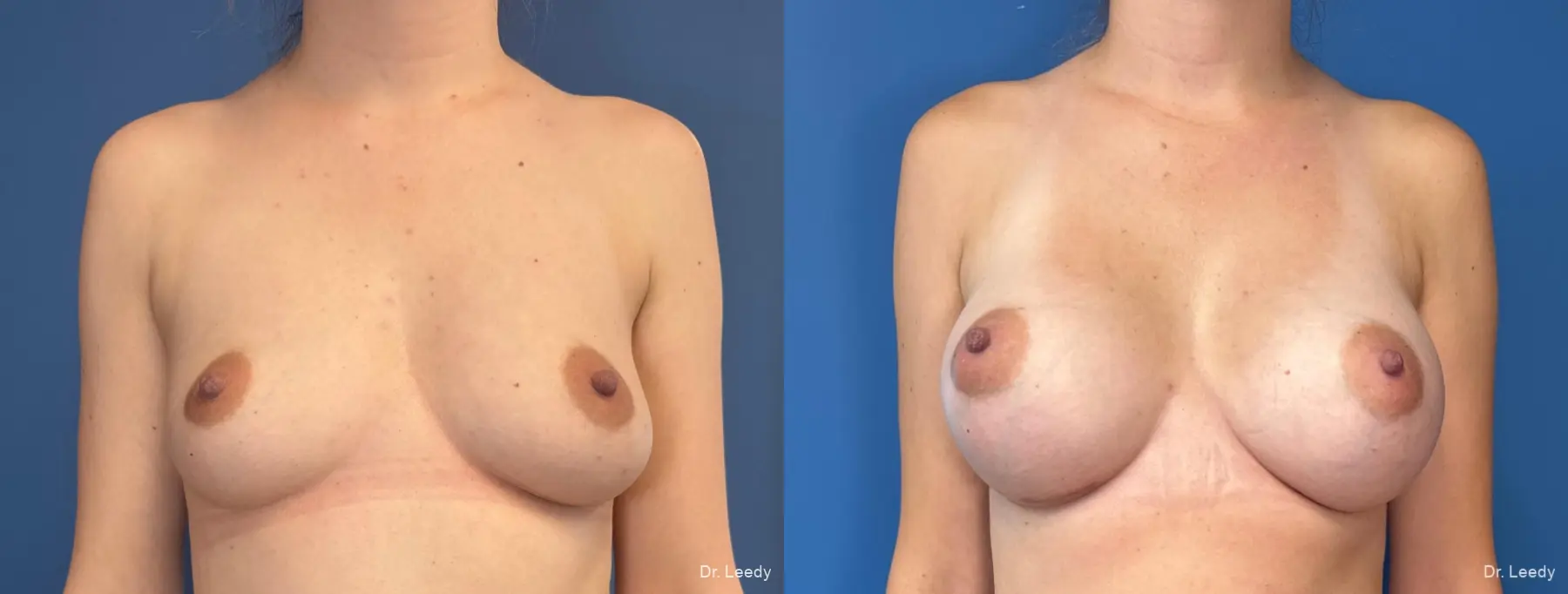 Breast Augmentation: Patient 38 - Before and After  