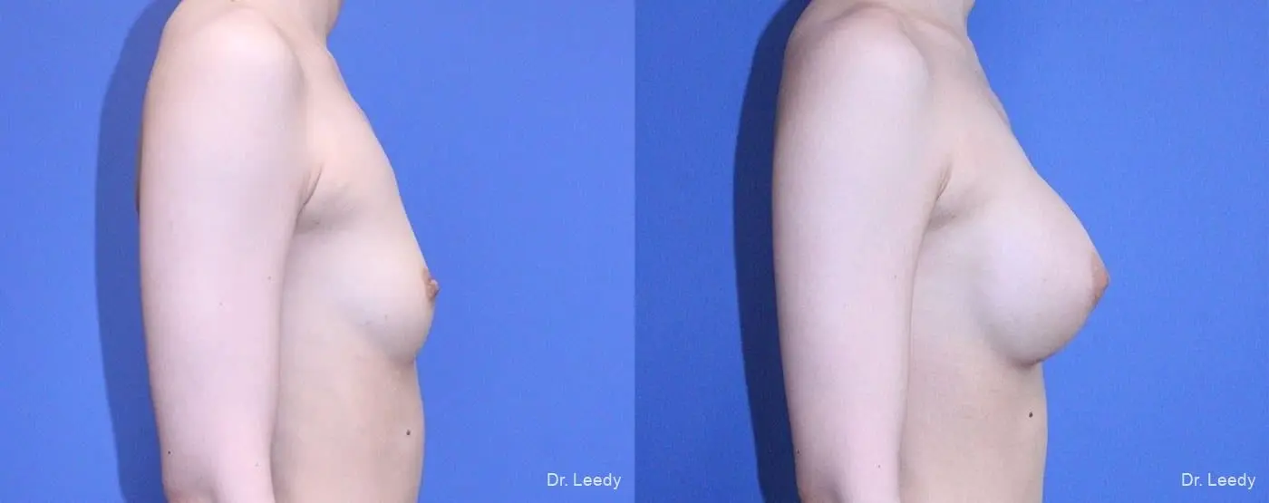 Breast Augmentation: Patient 4 - Before and After 3