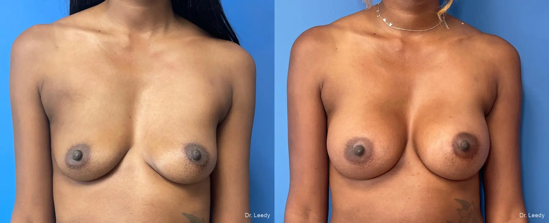 Breast Augmentation: Patient 14 - Before and After  