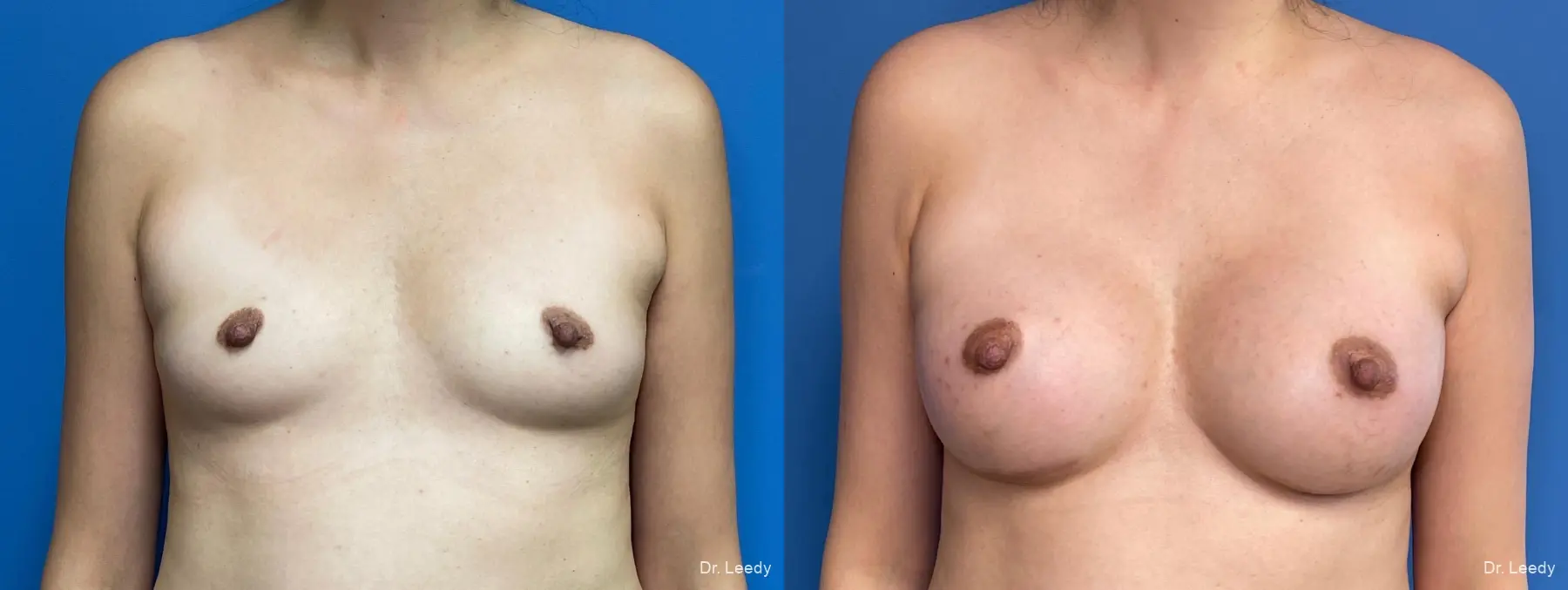 Breast Augmentation: Patient 1 - Before and After 1