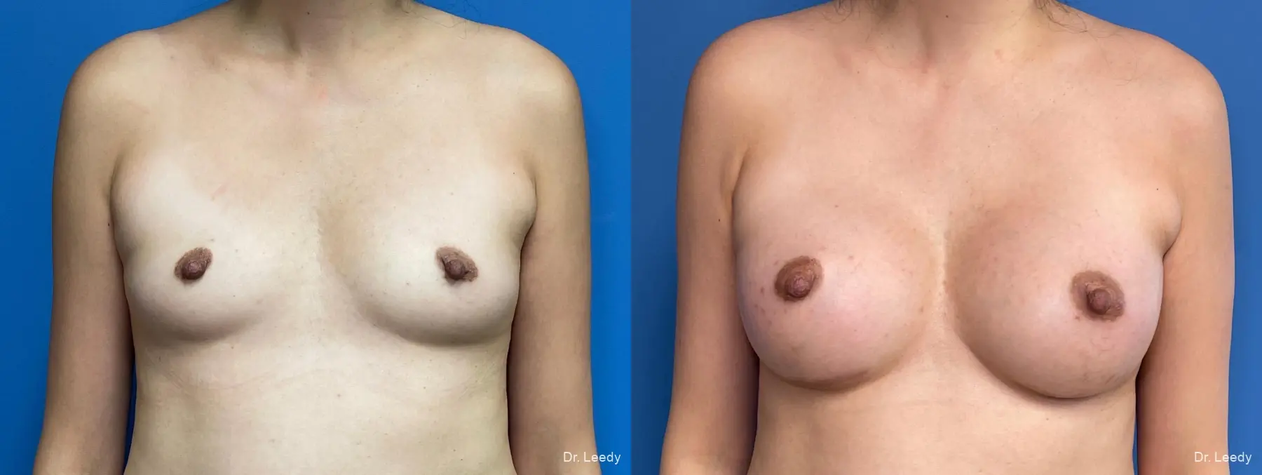 Breast Augmentation: Patient 6 - Before and After  