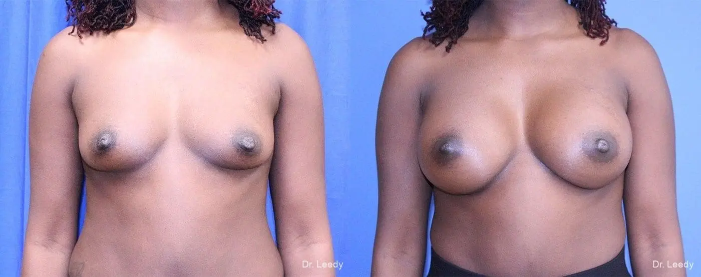 Breast Augmentation: Patient 7 - Before and After 1