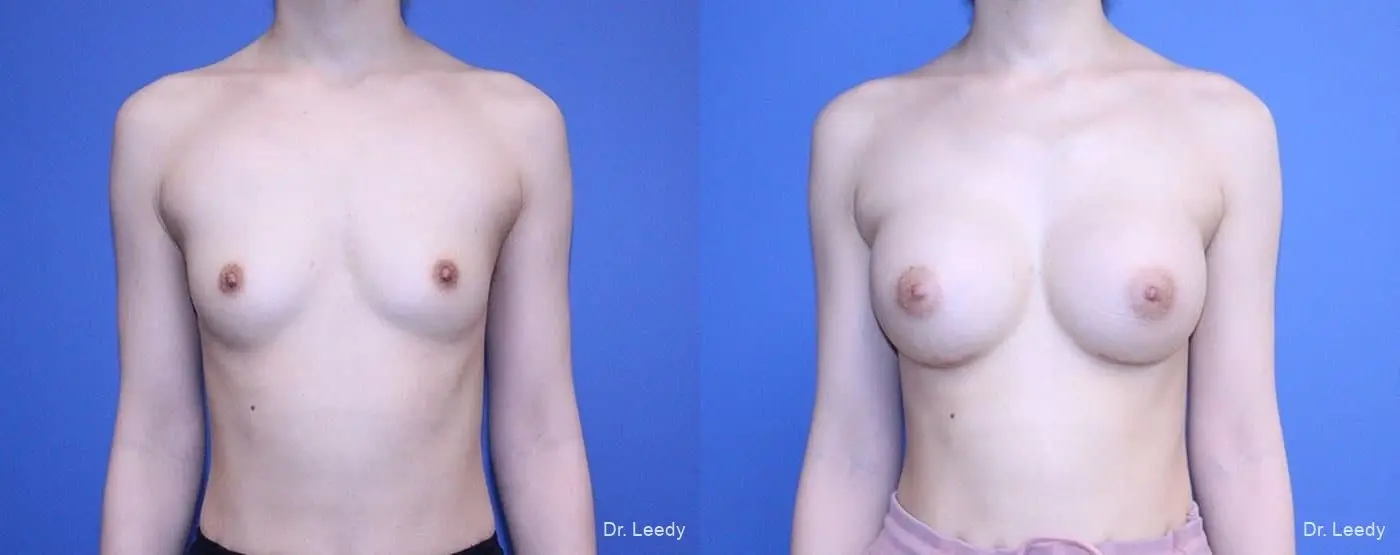 Breast Augmentation: Patient 4 - Before and After  