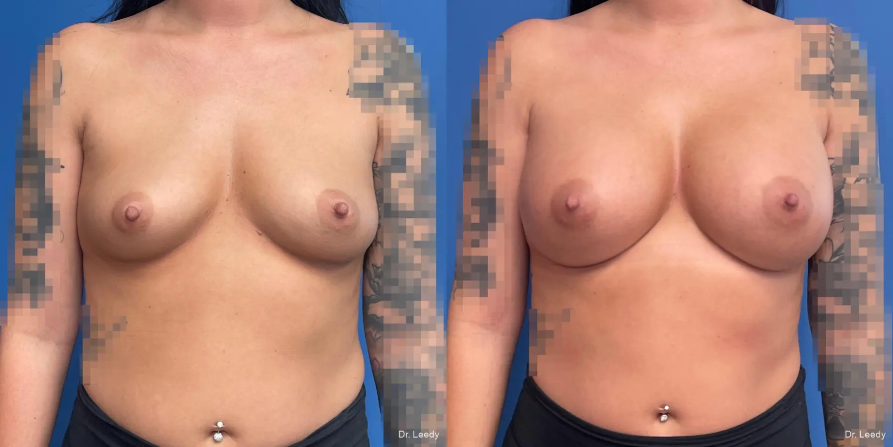 Breast Augmentation: Patient 18 - Before and After  