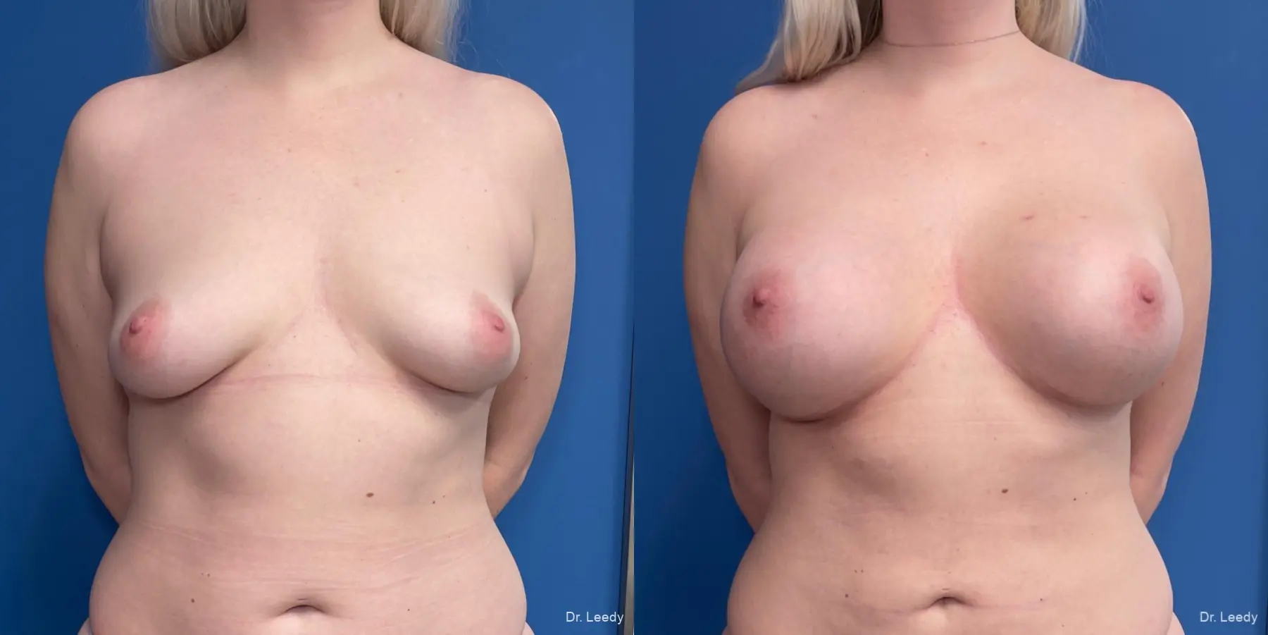 Breast Augmentation: Patient 19 - Before and After  
