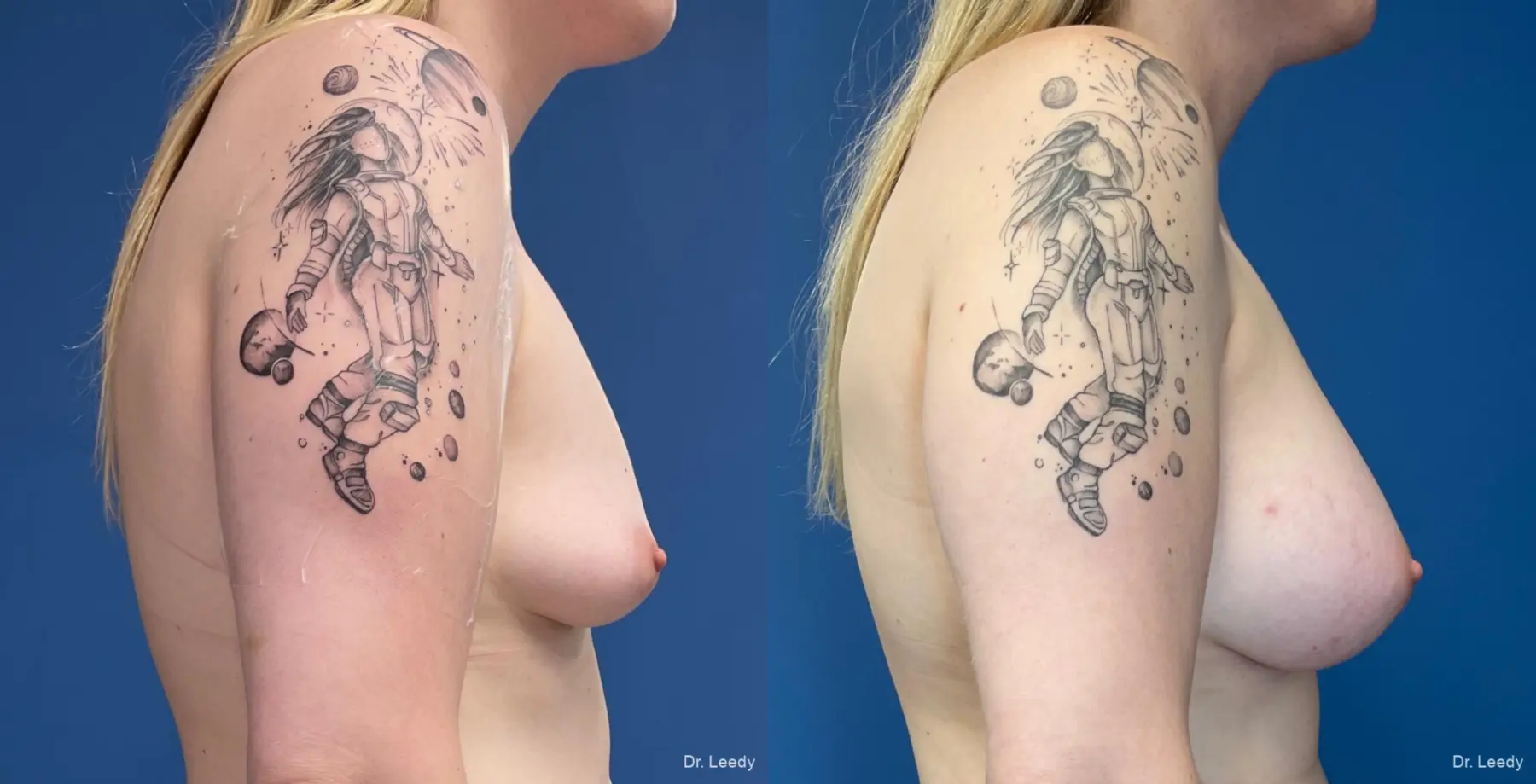 Breast Augmentation: Patient 21 - Before and After 3