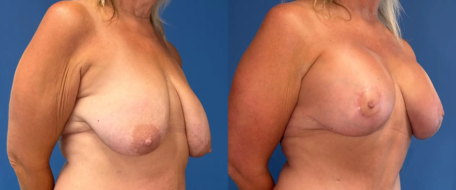 Breast Augmentation With Lift: Patient 11 - Before and After 2