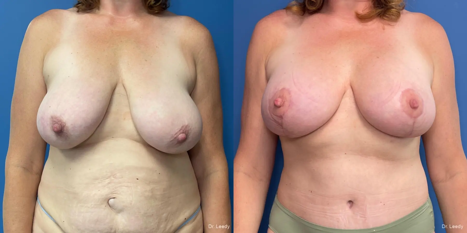 Breast Augmentation With Lift: Patient 1 - Before and After  