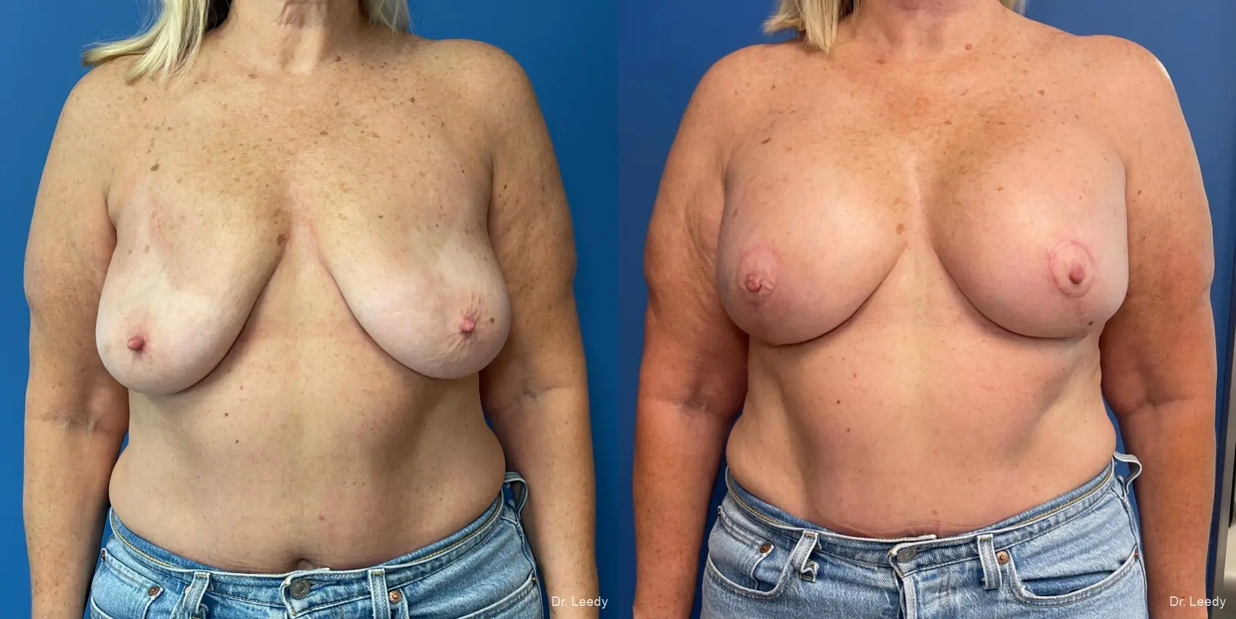 Breast Augmentation With Lift: Patient 2 - Before and After  