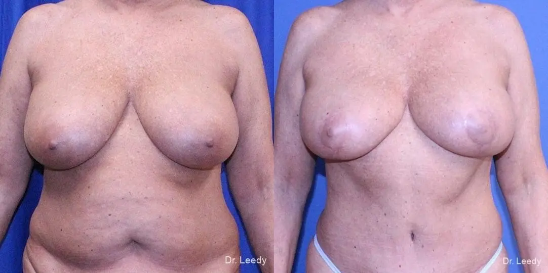 Breast Augmentation With Lift: Patient 3 - Before and After  