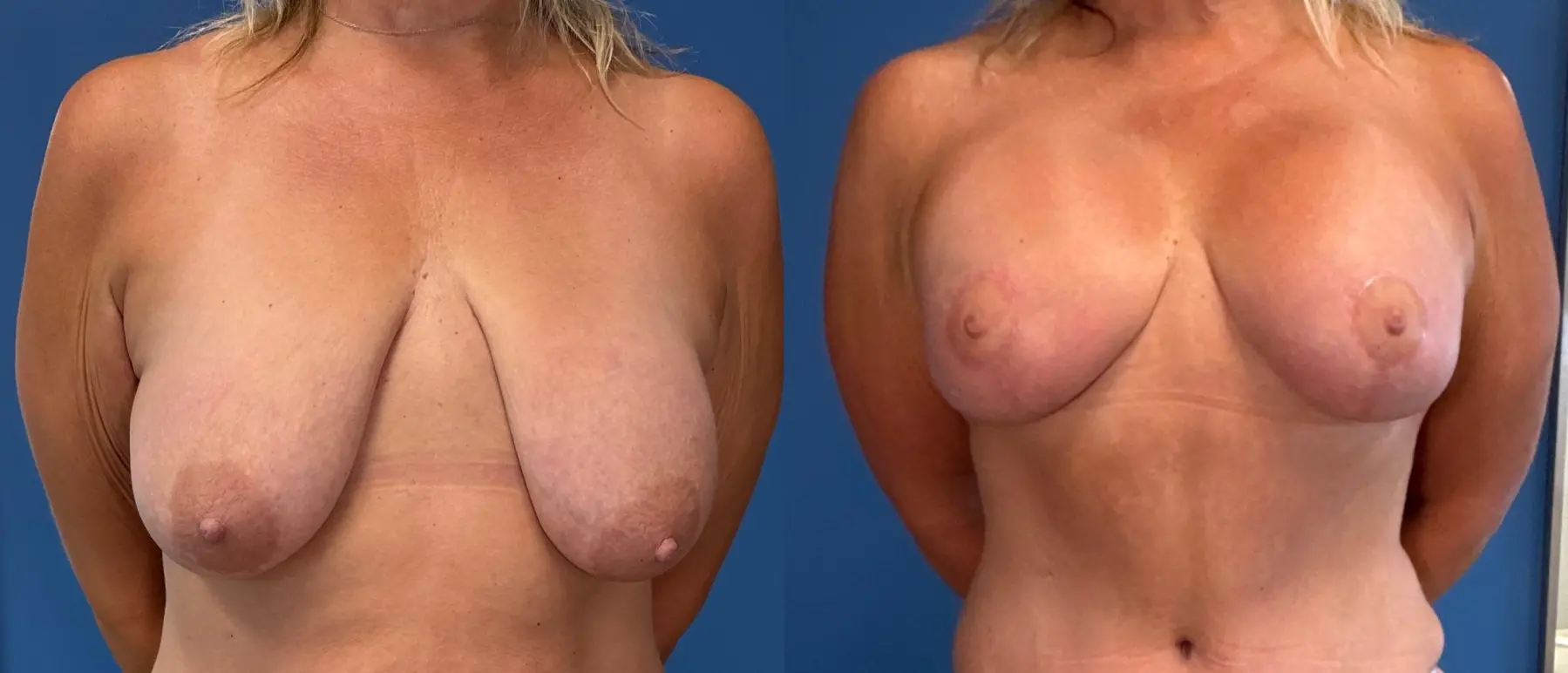 Breast Augmentation With Lift: Patient 11 - Before and After 1
