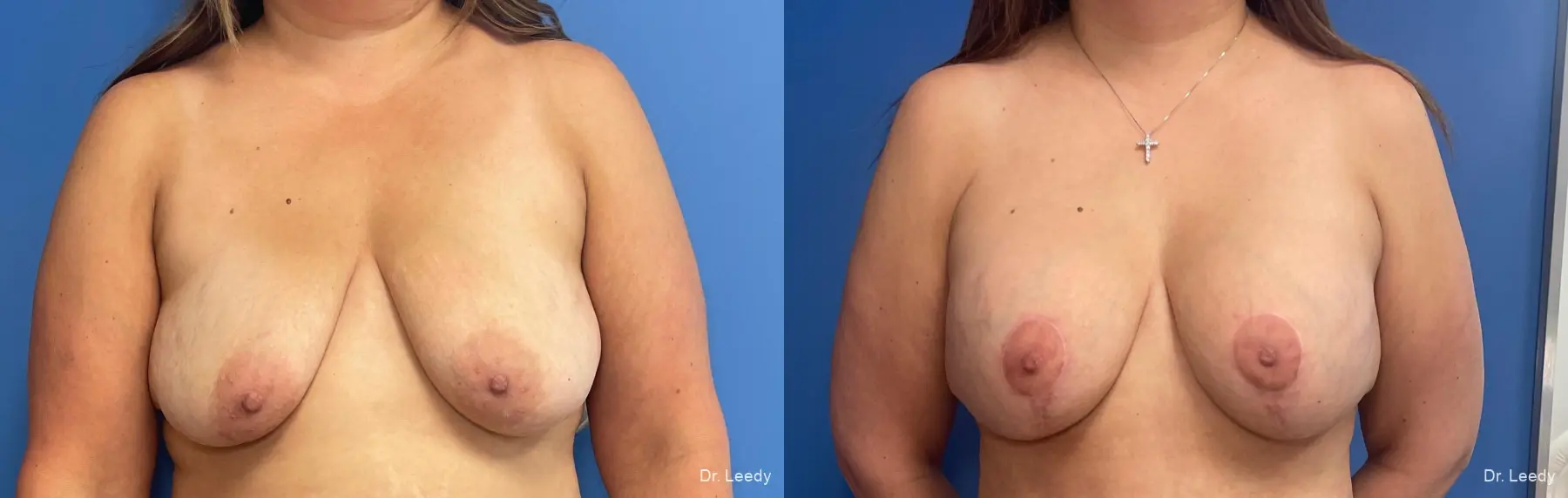 Breast Augmentation With Lift: Patient 5 - Before and After  