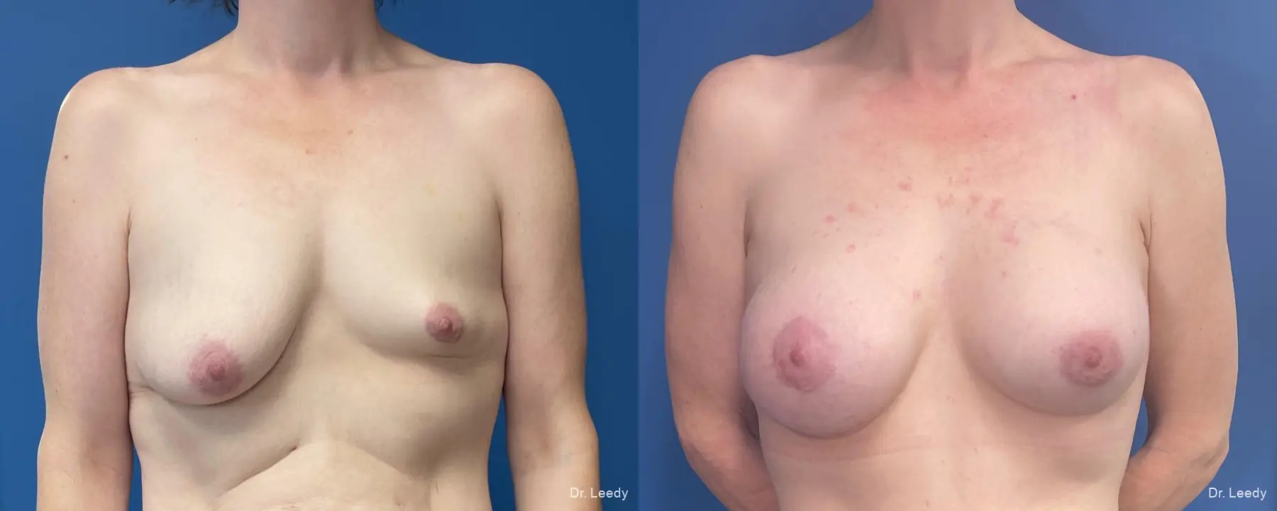 Breast Augmentation With Lift: Patient 5 - Before and After  