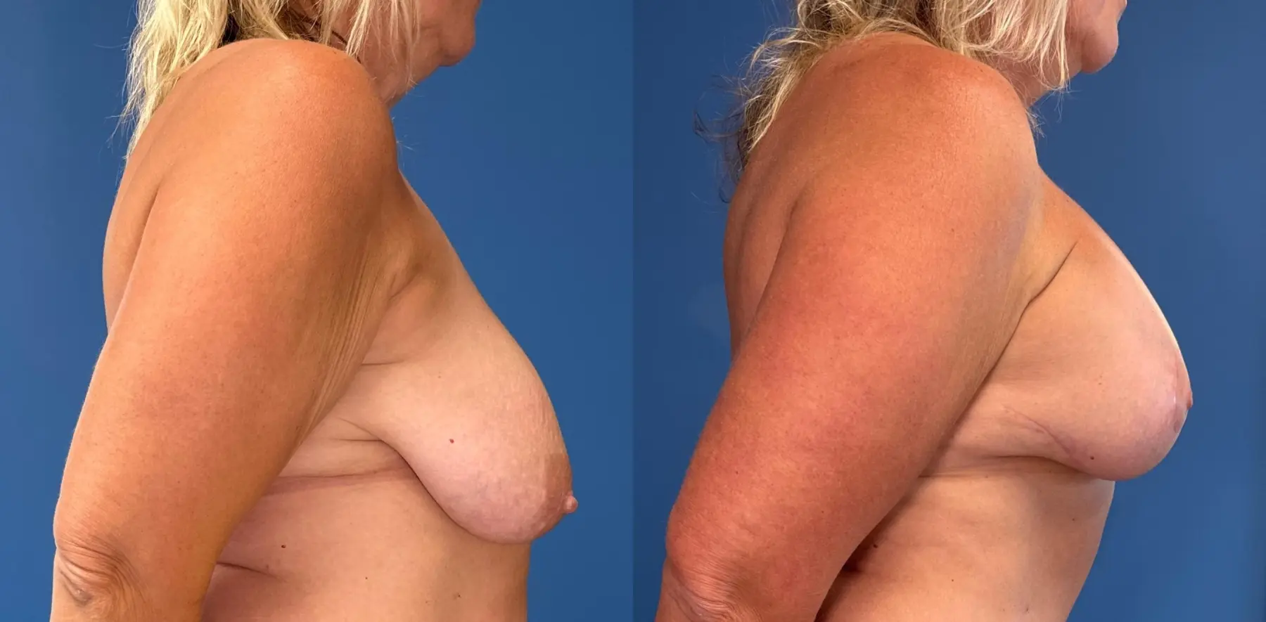 Breast Augmentation With Lift: Patient 11 - Before and After 3