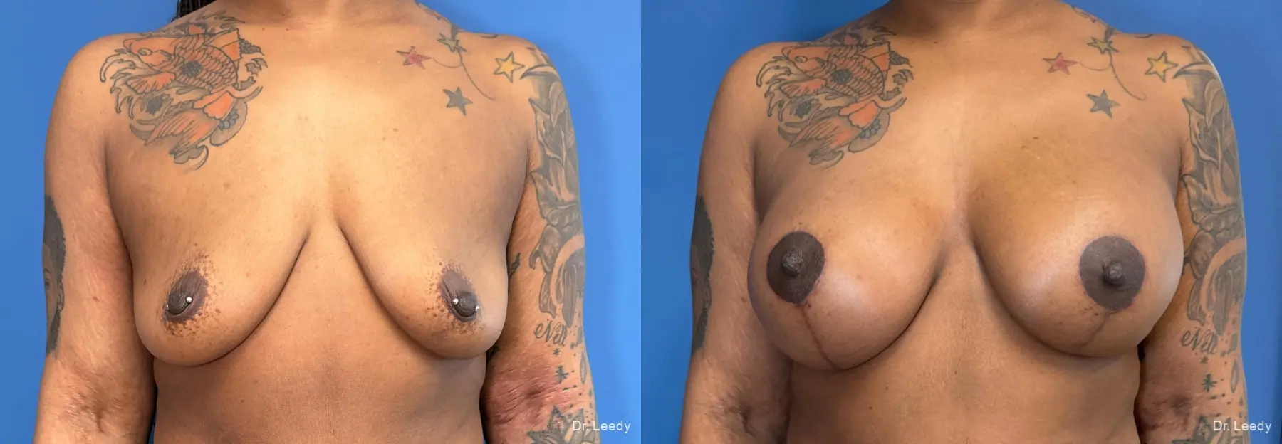 Breast Augmentation With Lift: Patient 12 - Before and After  