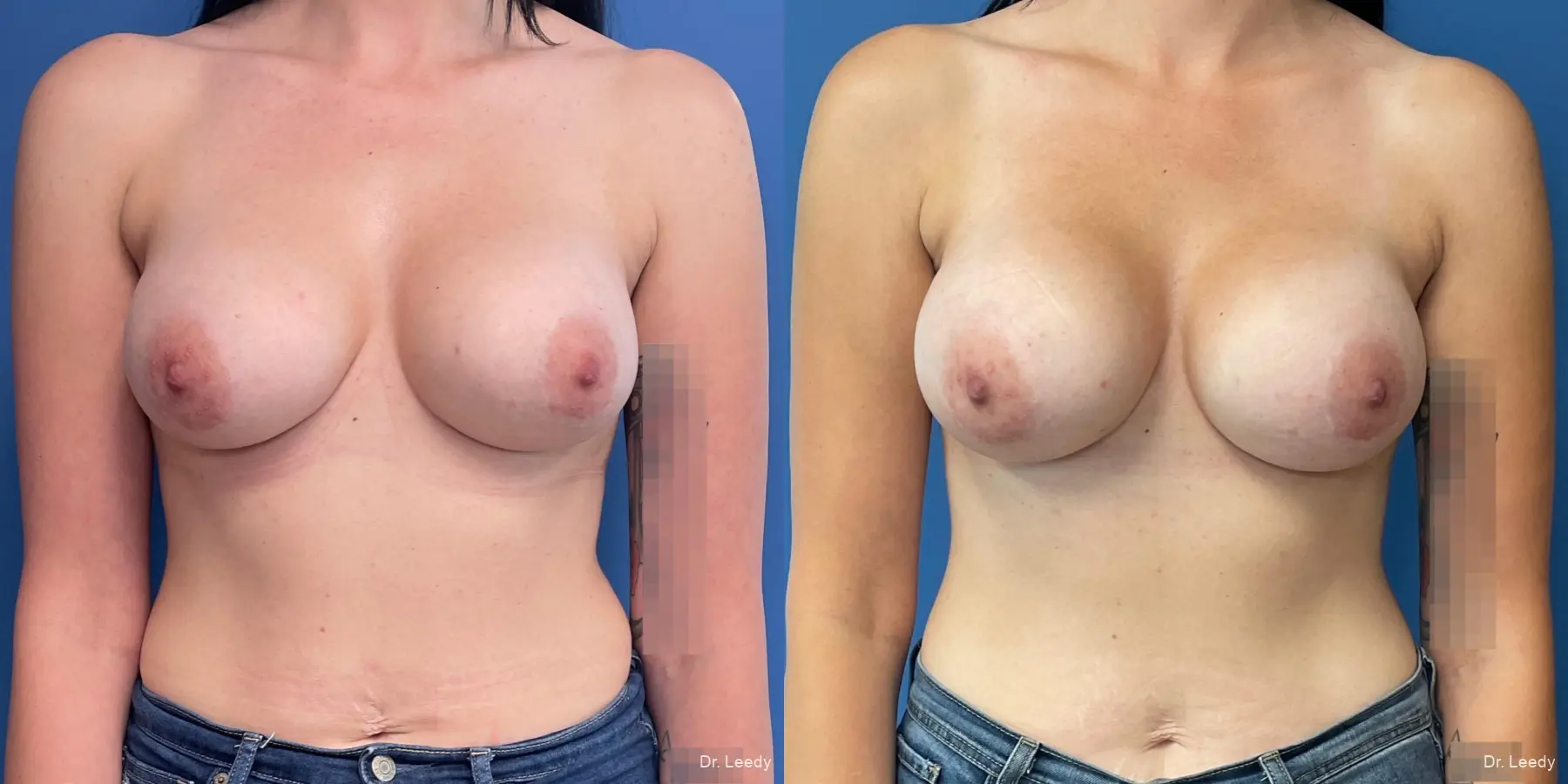 Breast Implant Exchange: Patient 2 - Before and After  