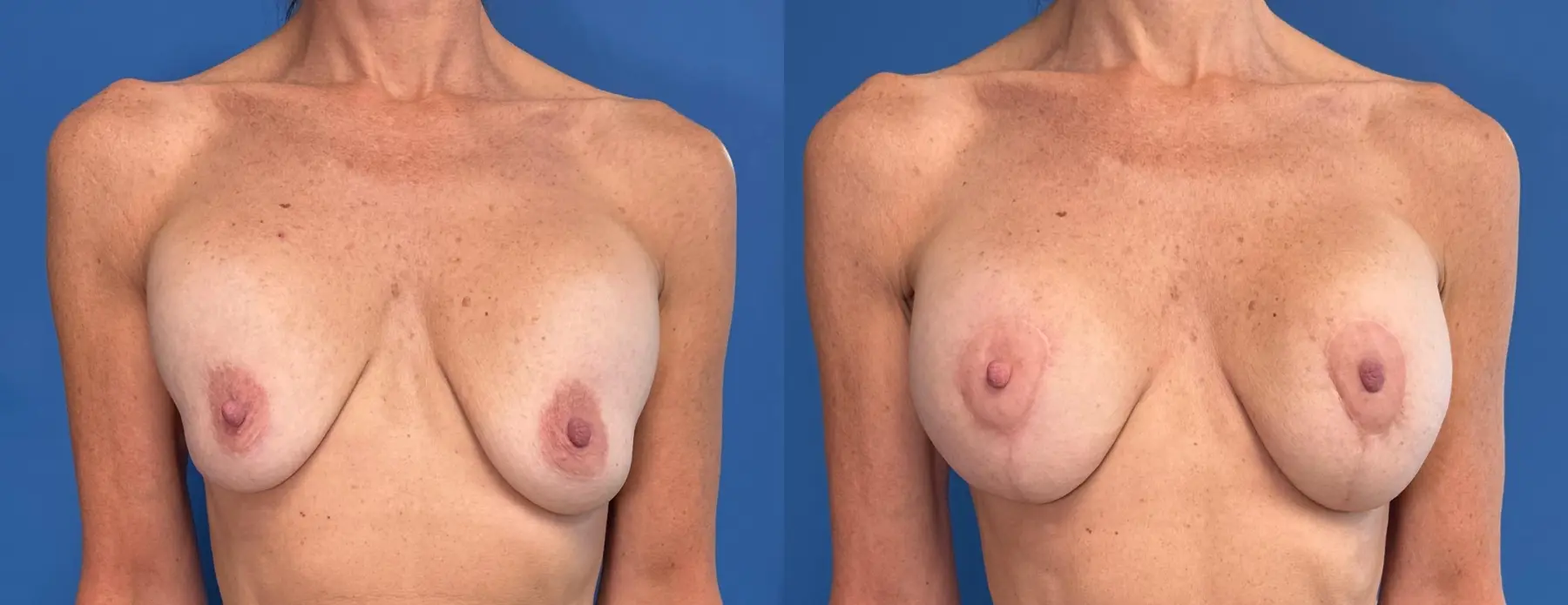 Breast Implant Exchange: Patient 9 - Before and After