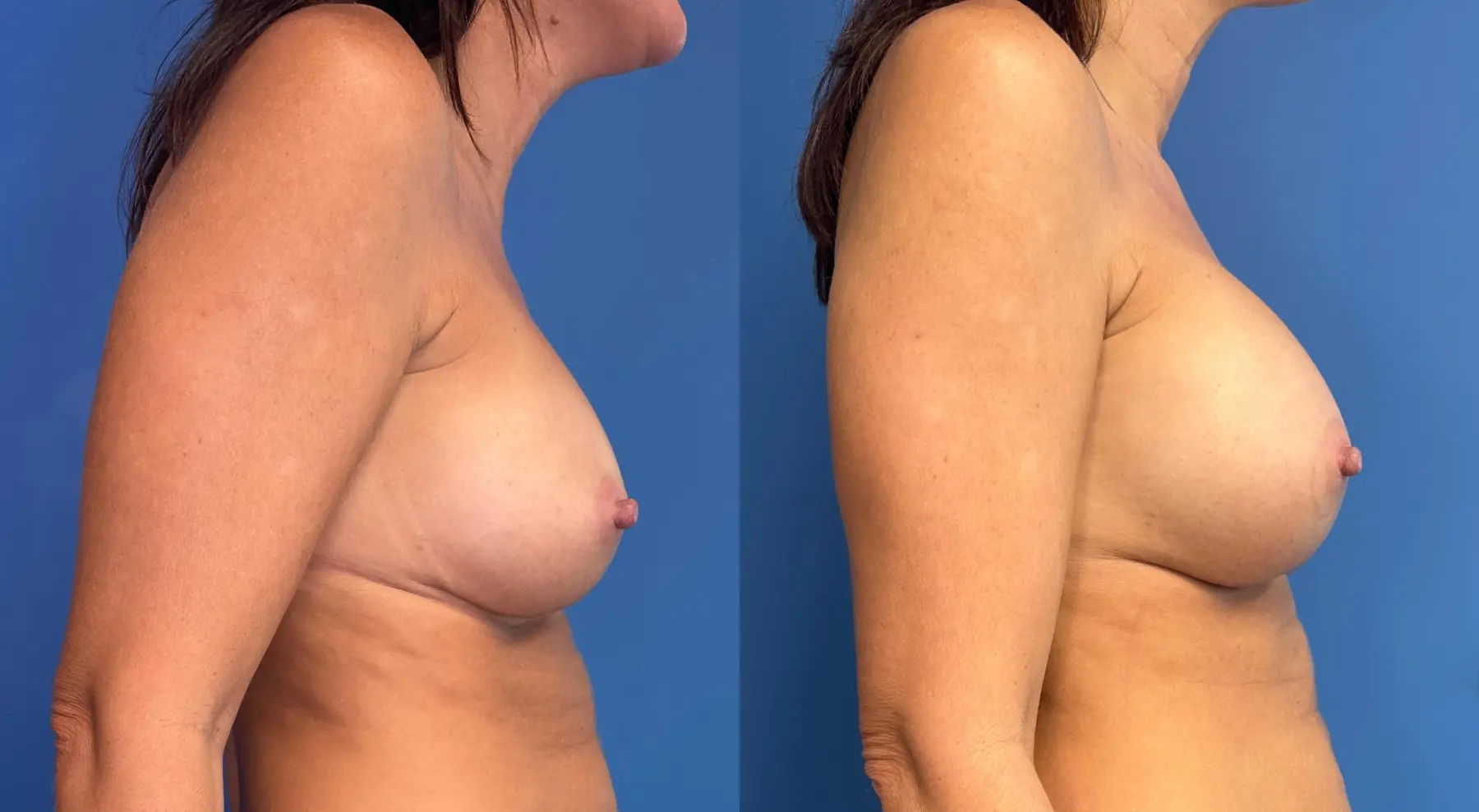Breast Implant Exchange: Patient 14 - Before and After 3