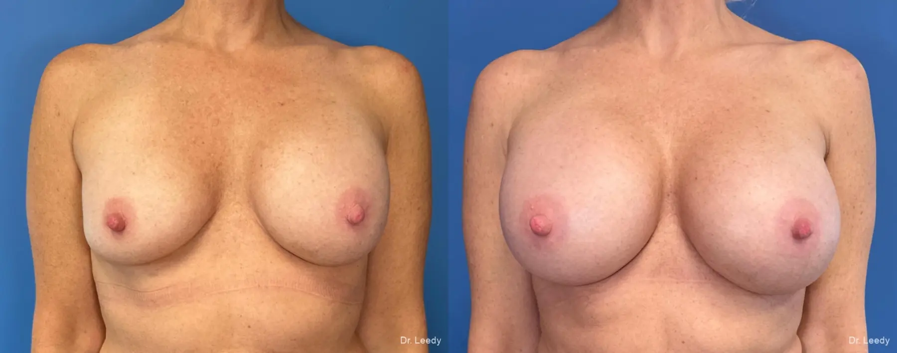 Breast Implant Exchange: Patient 8 - Before and After  