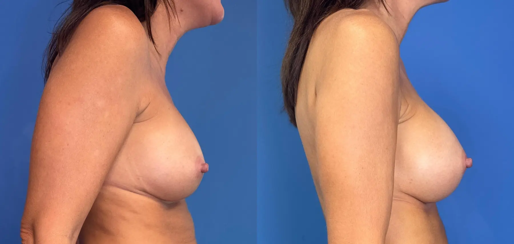 Breast Implant Exchange: Patient 14 - Before and After 3