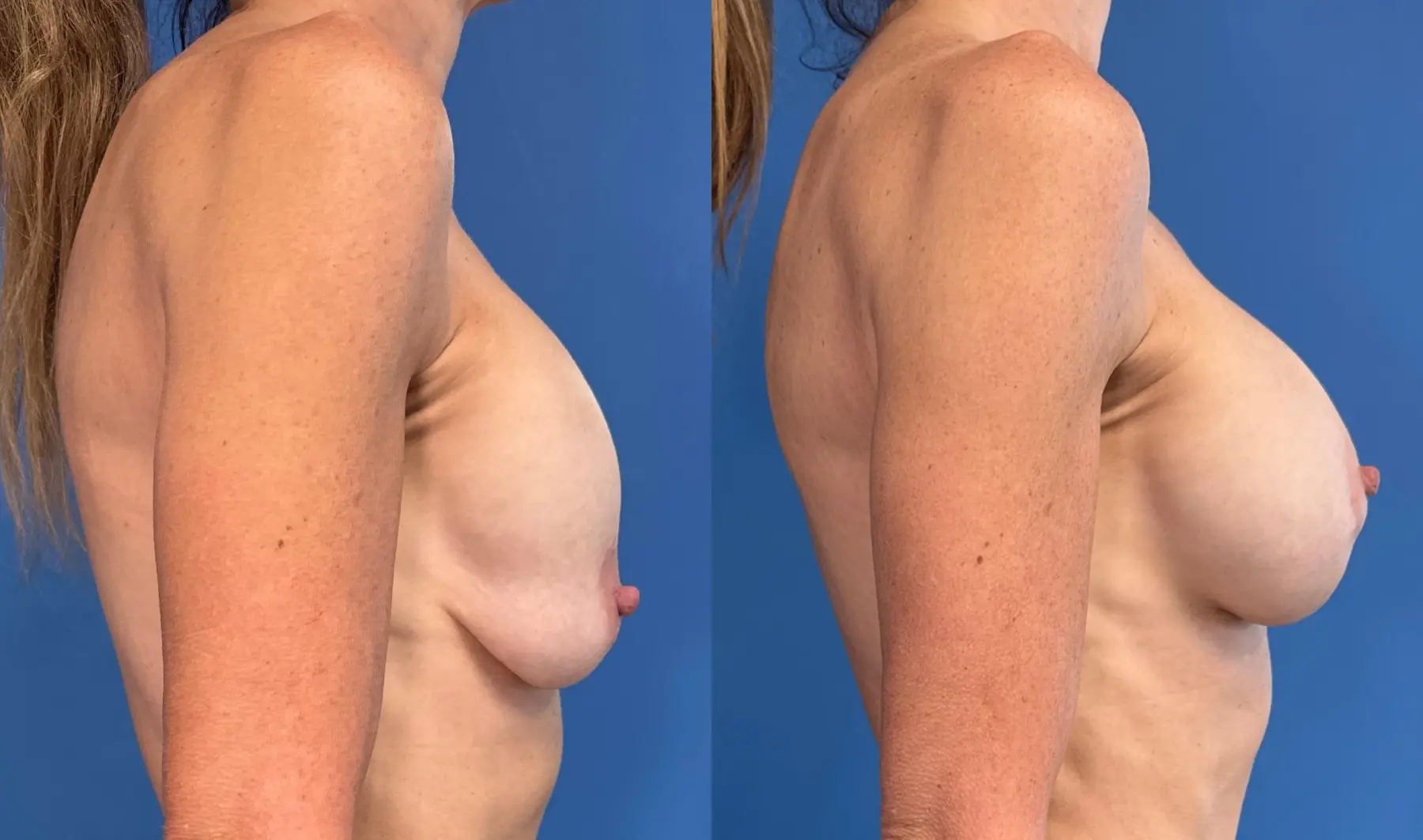 Breast Implant Exchange: Patient 9 - Before and After 3