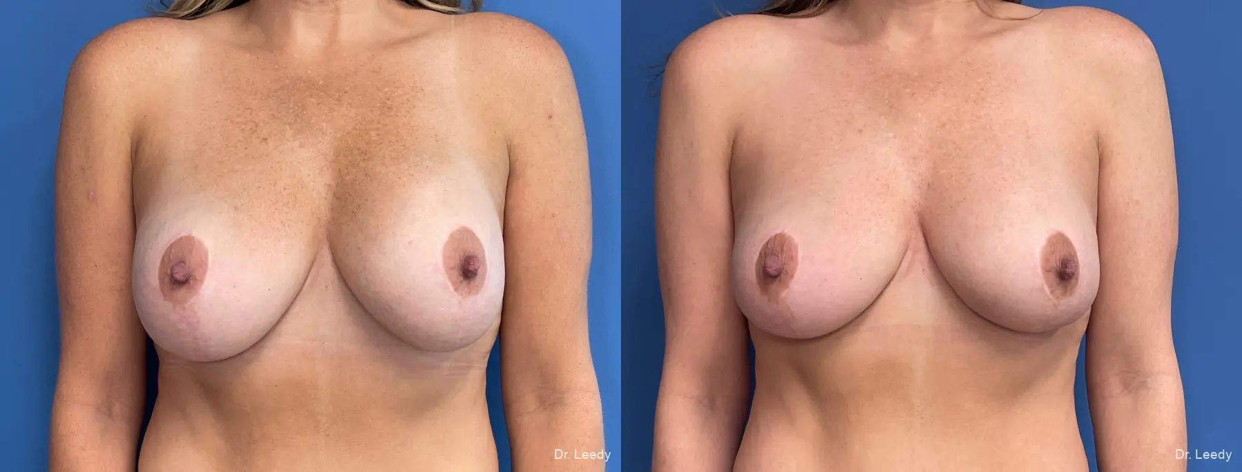 Breast Implant Exchange: Patient 6 - Before and After  