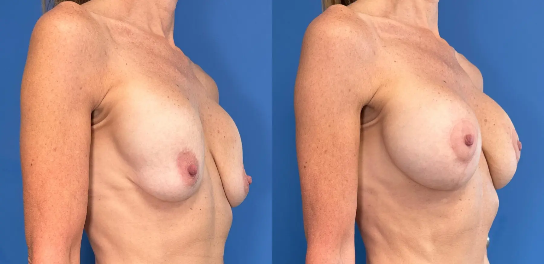 Breast Implant Exchange: Patient 9 - Before and After 2