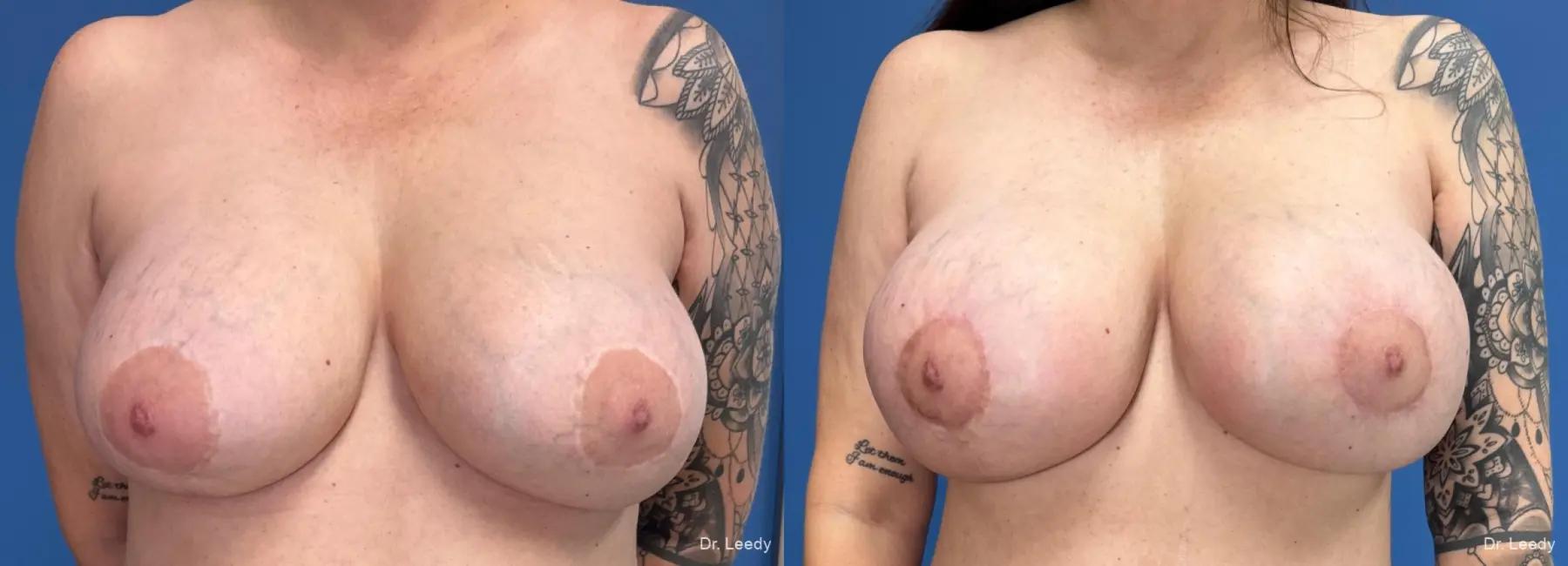 Breast Implant Exchange: Patient 10 - Before and After  