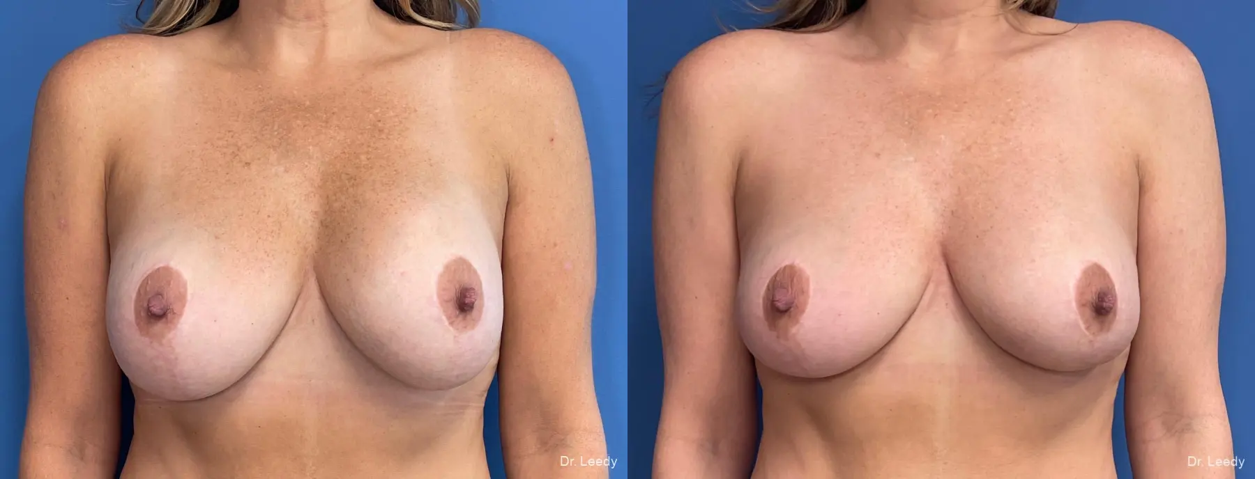 Breast Implant Exchange: Patient 5 - Before and After 1