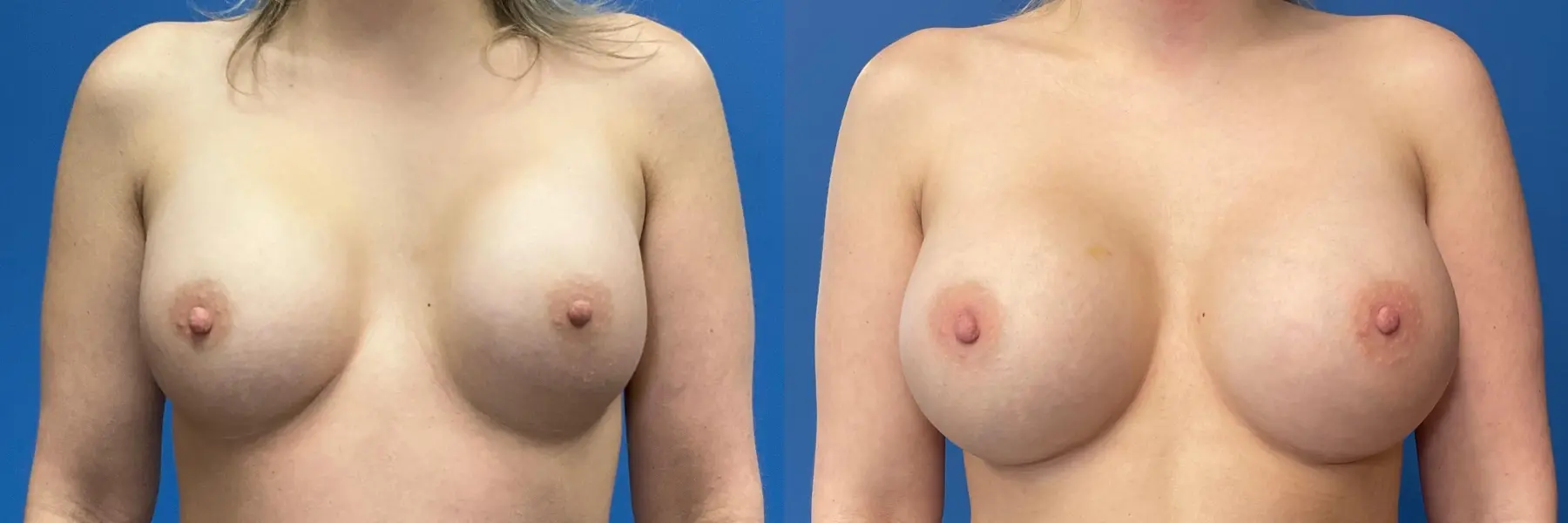 Breast Implant Exchange: Patient 1 - Before and After  