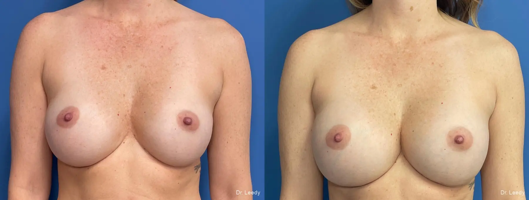 Breast Implant Exchange: Patient 4 - Before and After  