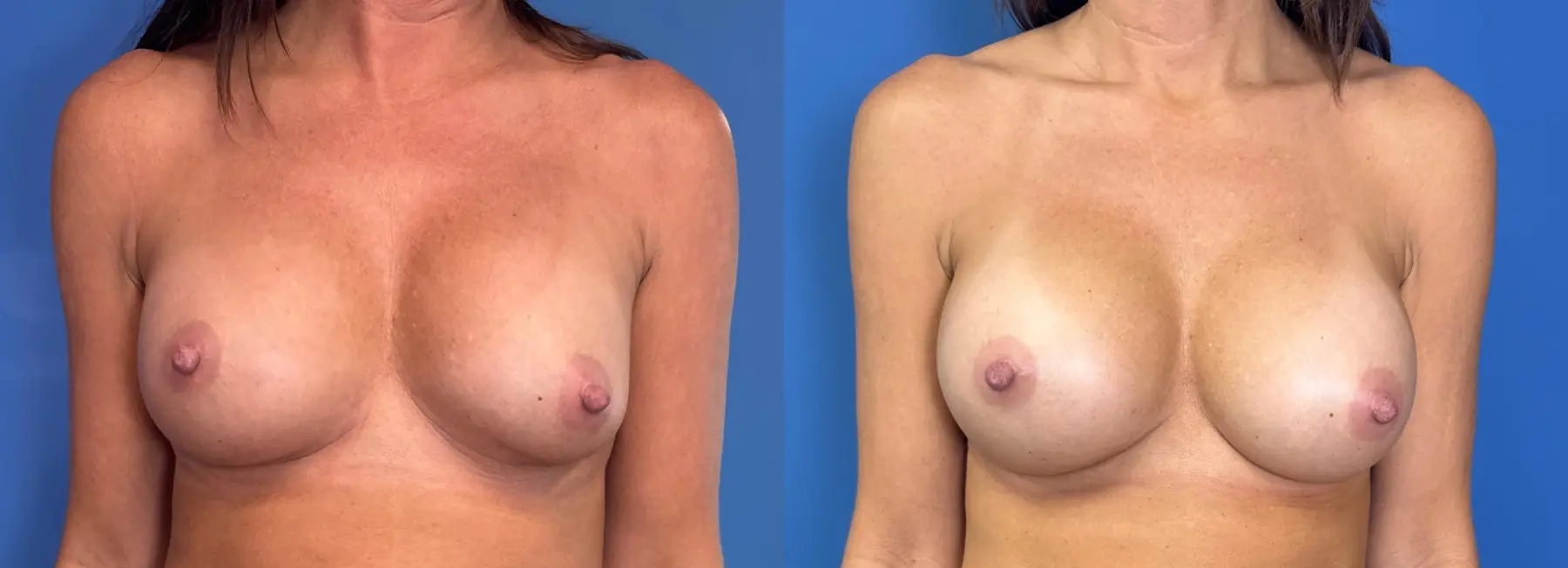 Breast Implant Exchange: Patient 14 - Before and After 1