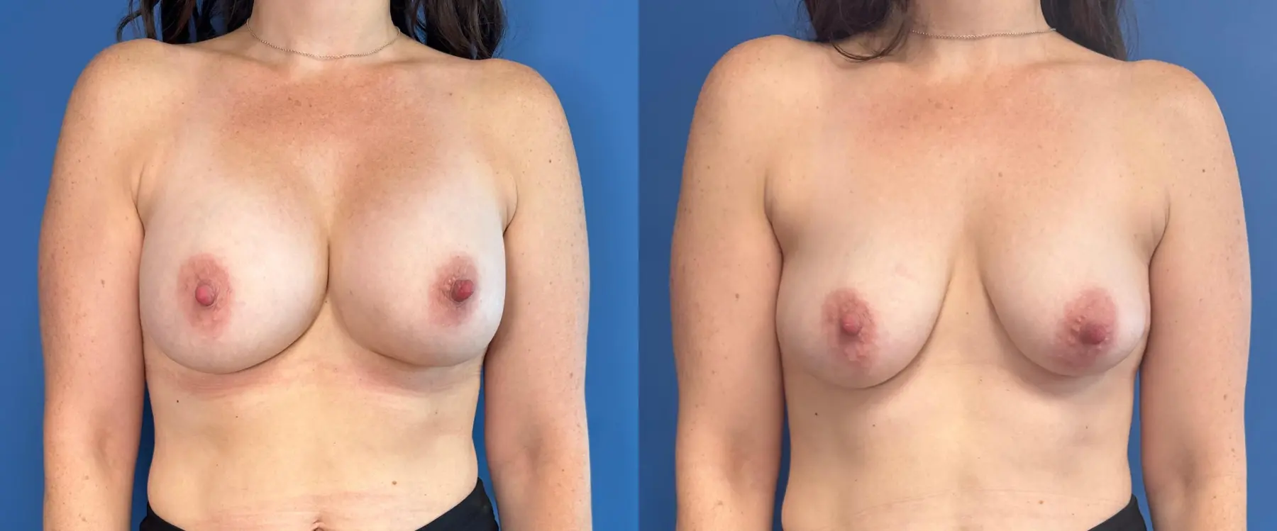 Breast Implant Removal: Patient 1 - Before and After  