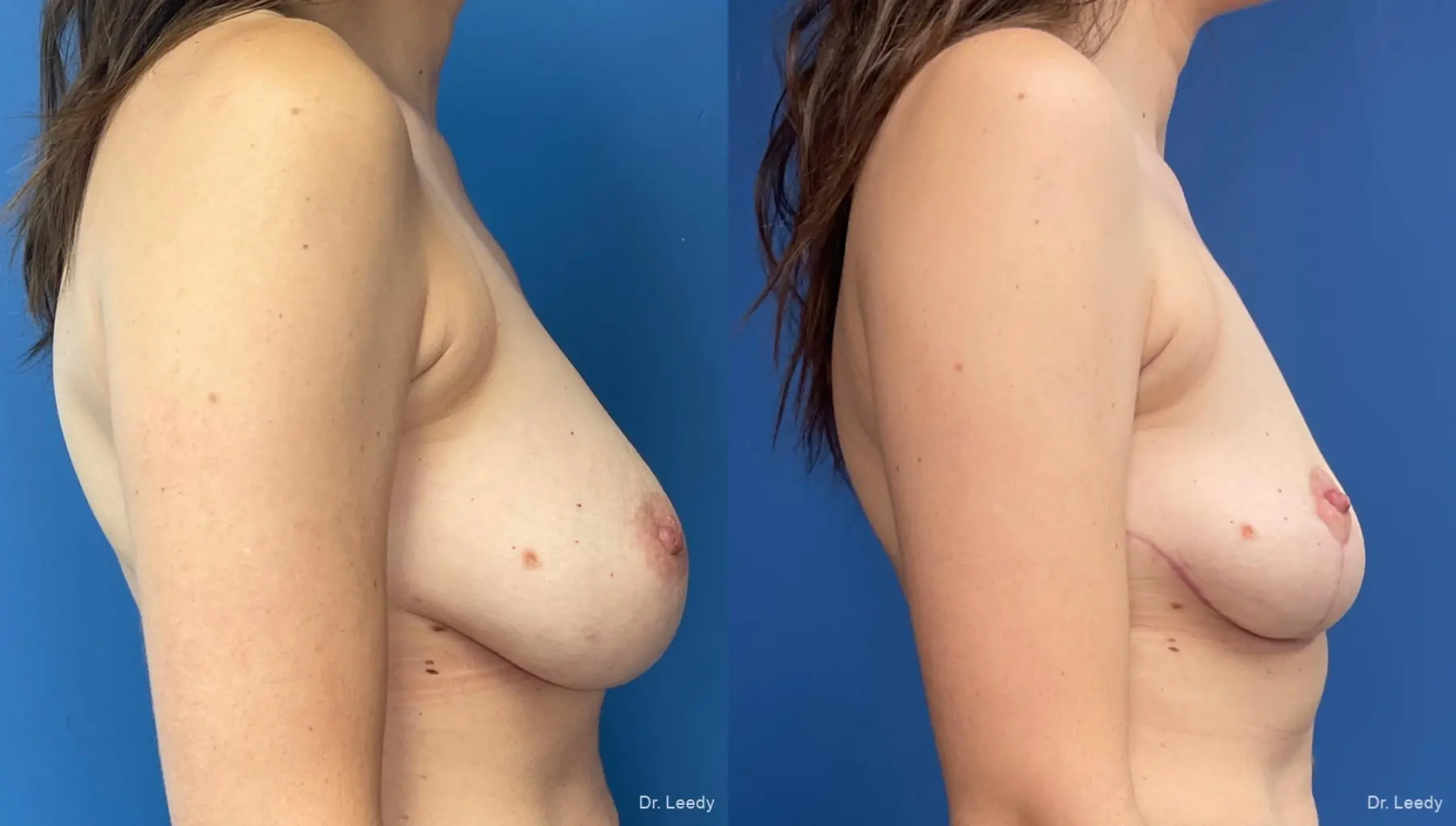 Breast Implant Removal With Lift: Patient 2 - Before and After 3
