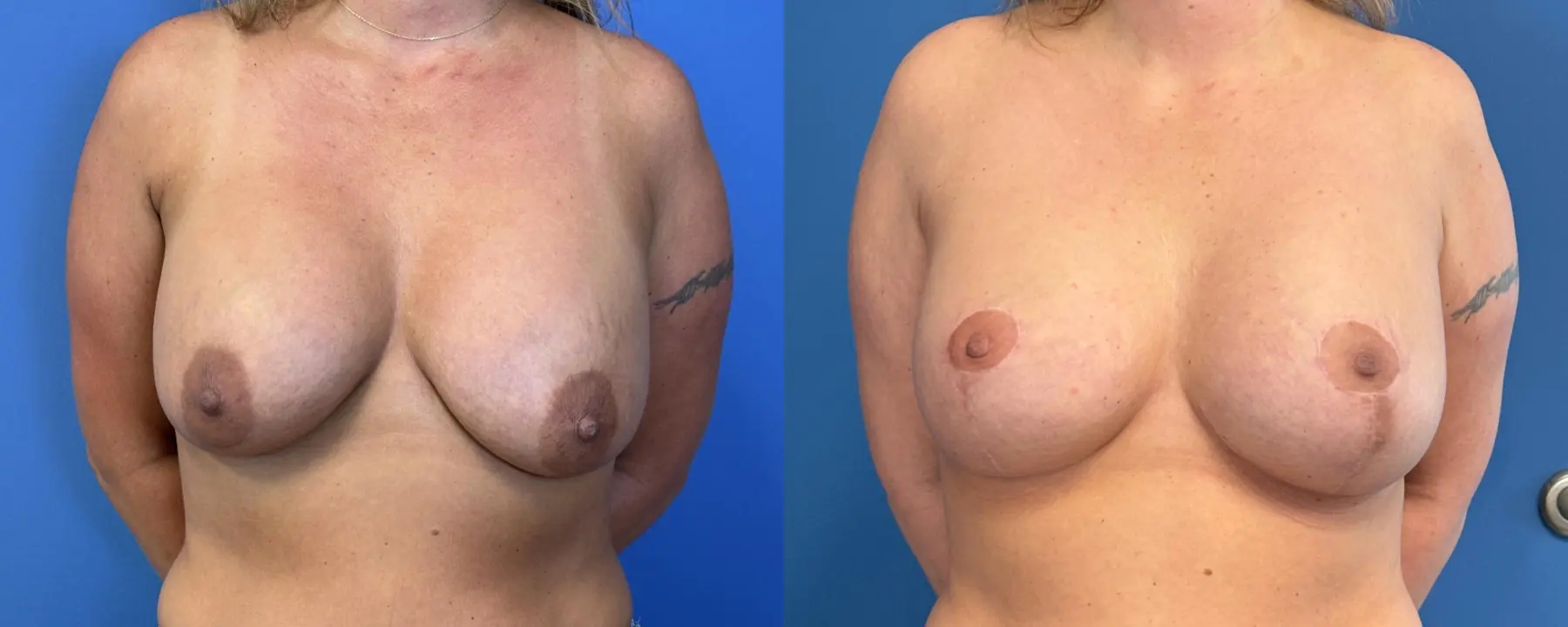 Breast Implant Removal With Lift: Patient 3 - Before and After  
