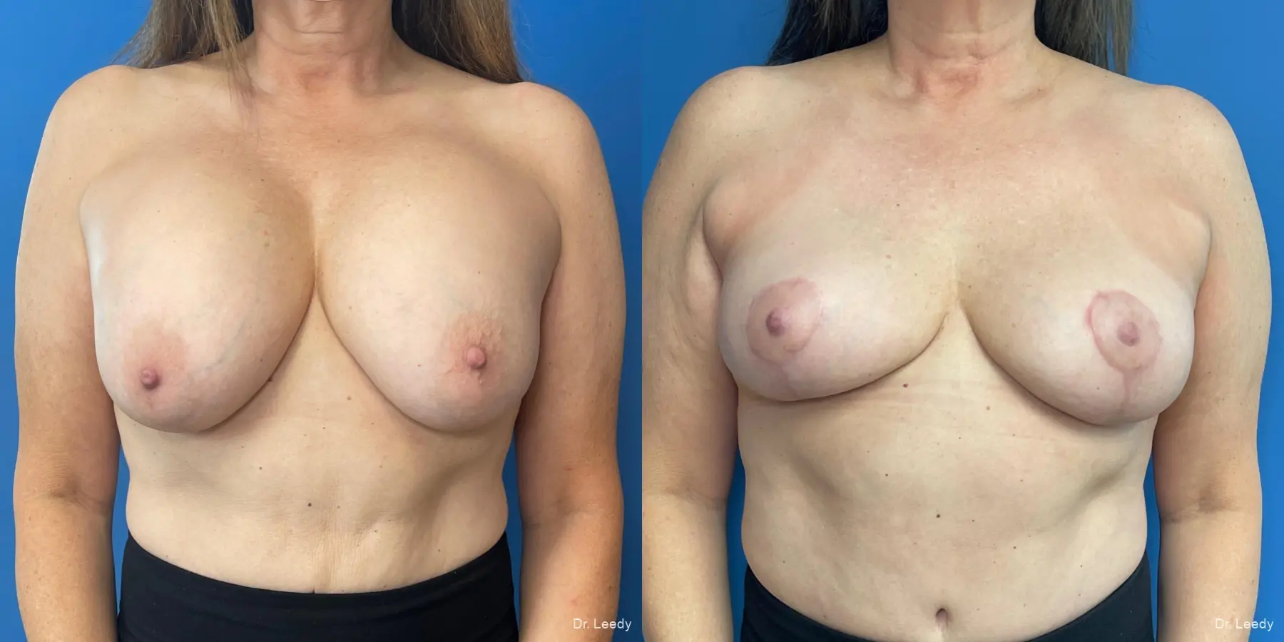 Breast Implant Removal With Lift: Patient 1 - Before and After  