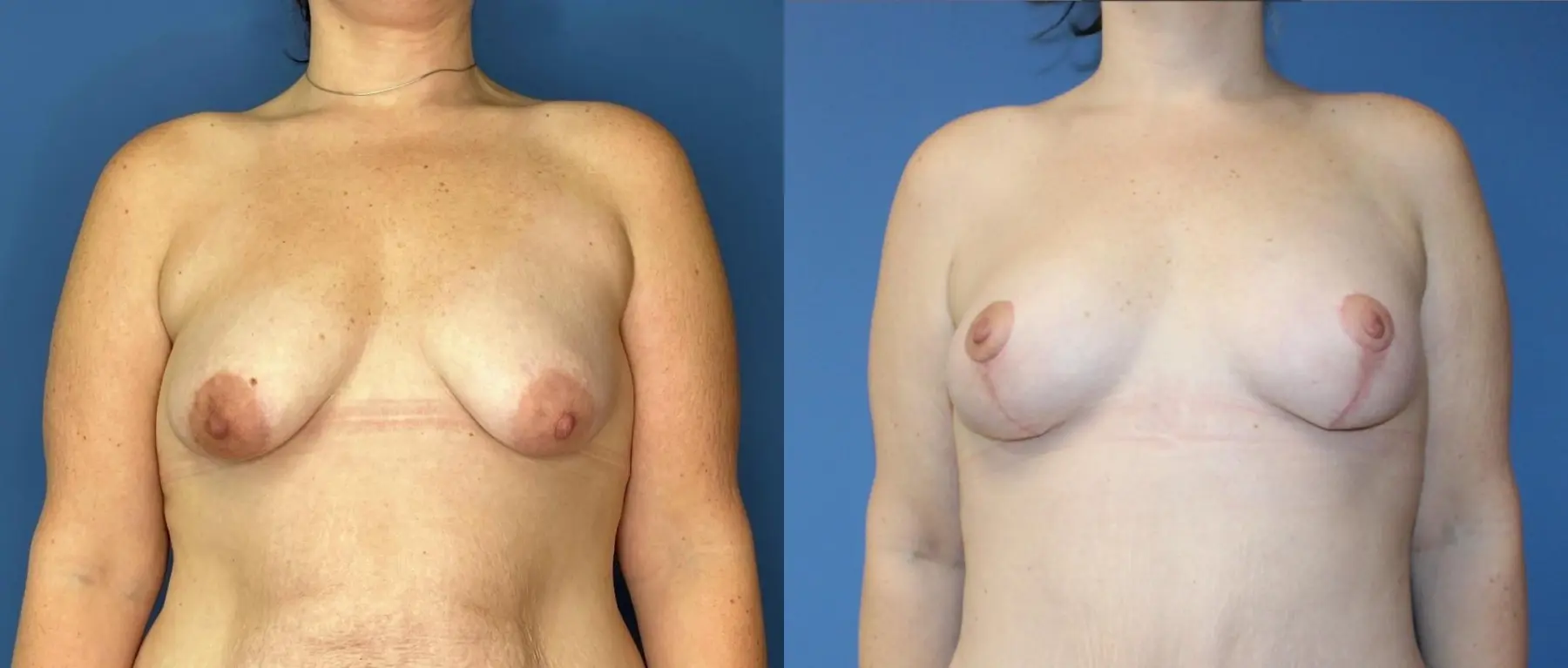 Breast Lift - Fat: Patient 1 - Before and After  