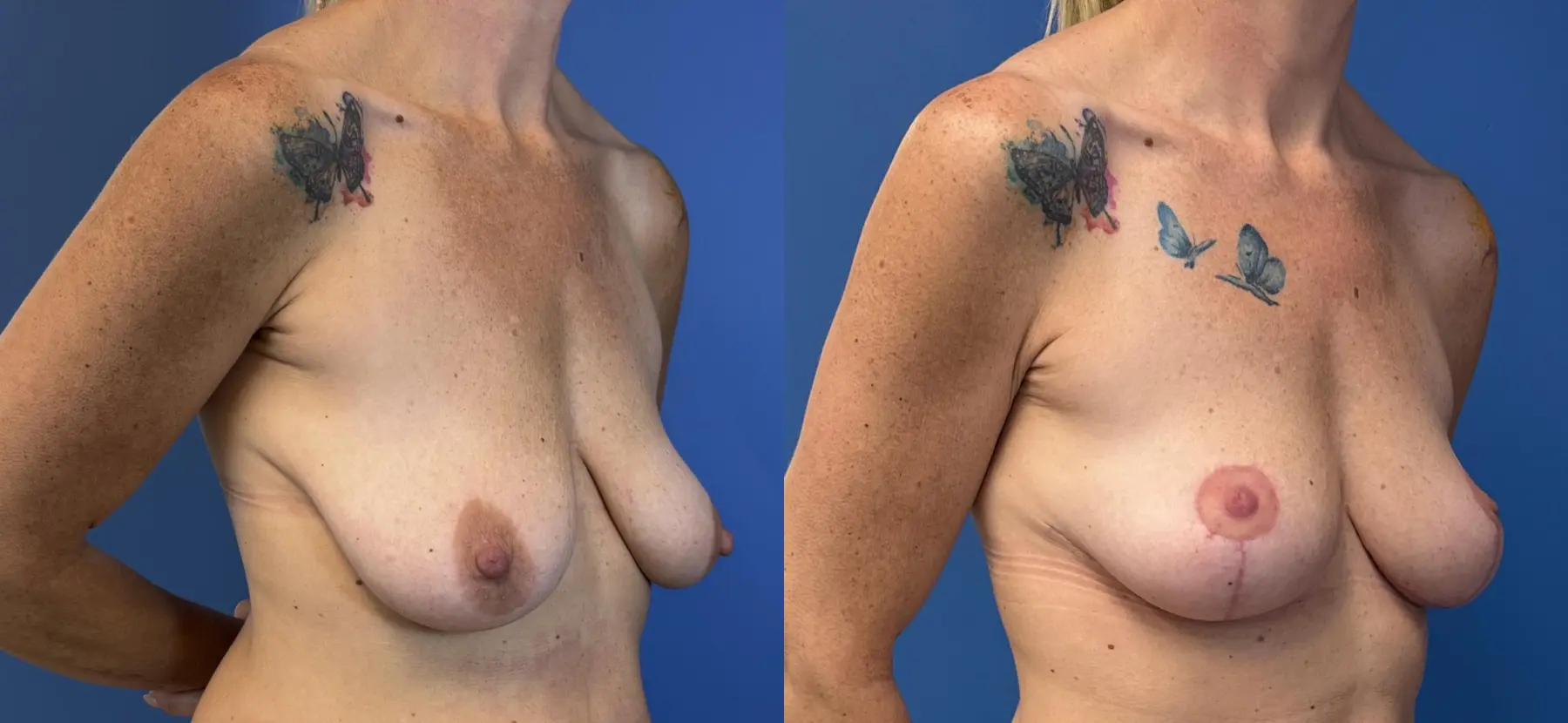 Breast Lift - Fat: Patient 3 - Before and After 2