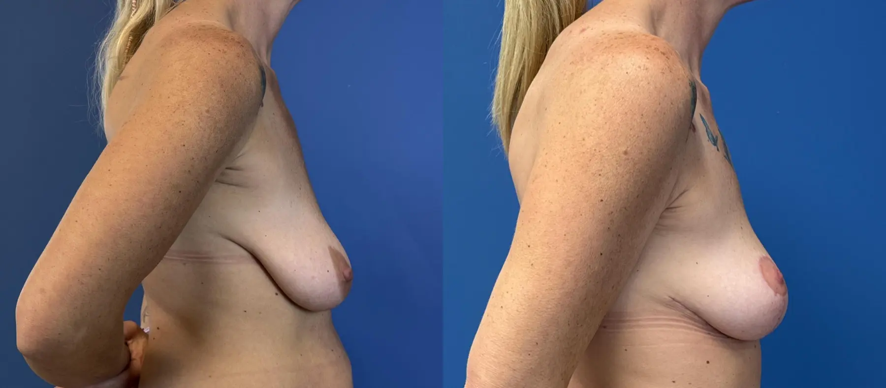 Breast Lift - Fat: Patient 3 - Before and After 3