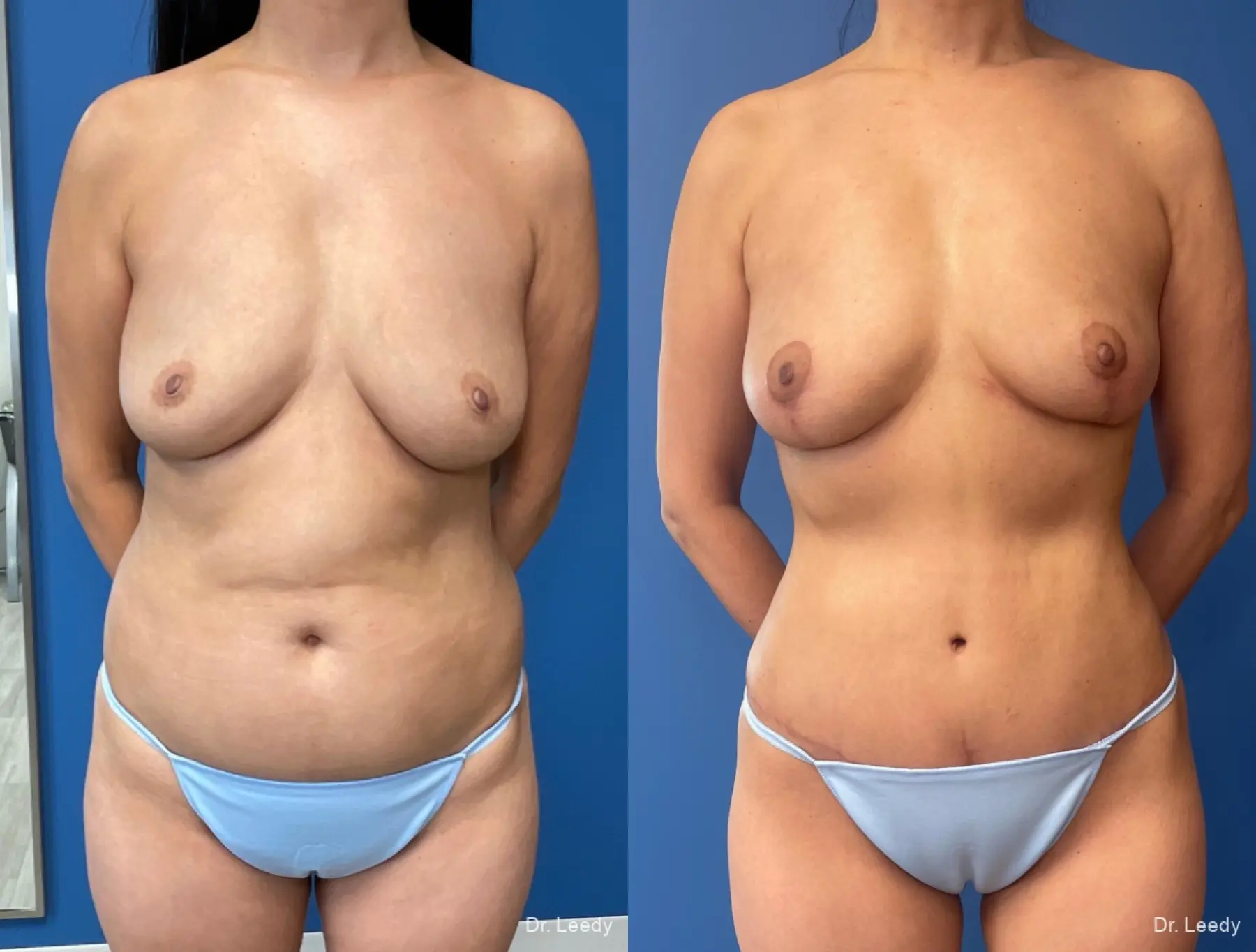 Breast Lift - Fat: Patient 2 - Before and After  