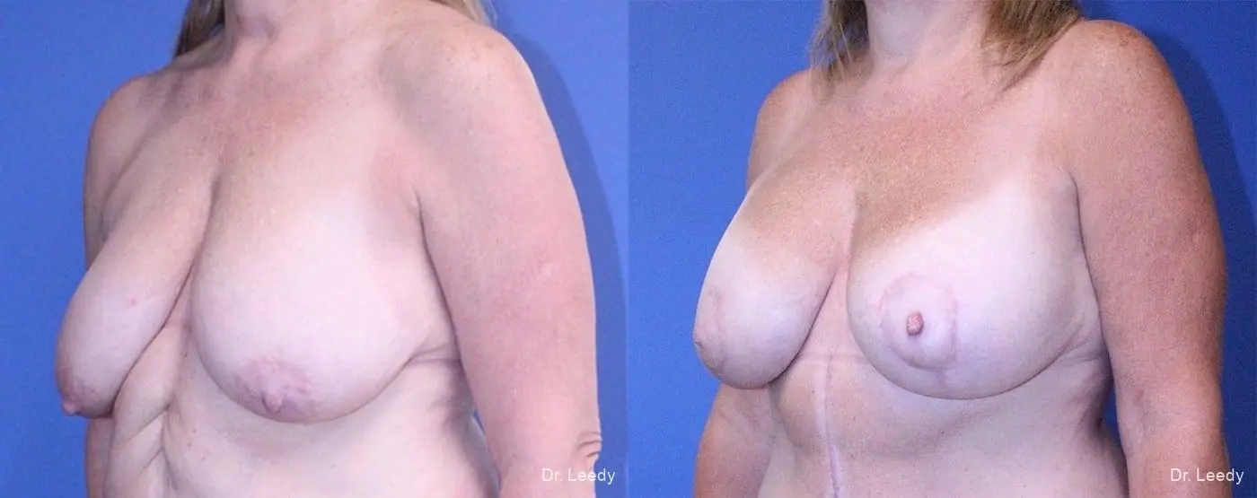 Breast Lift And Augmentation: Patient 5 - Before and After 4