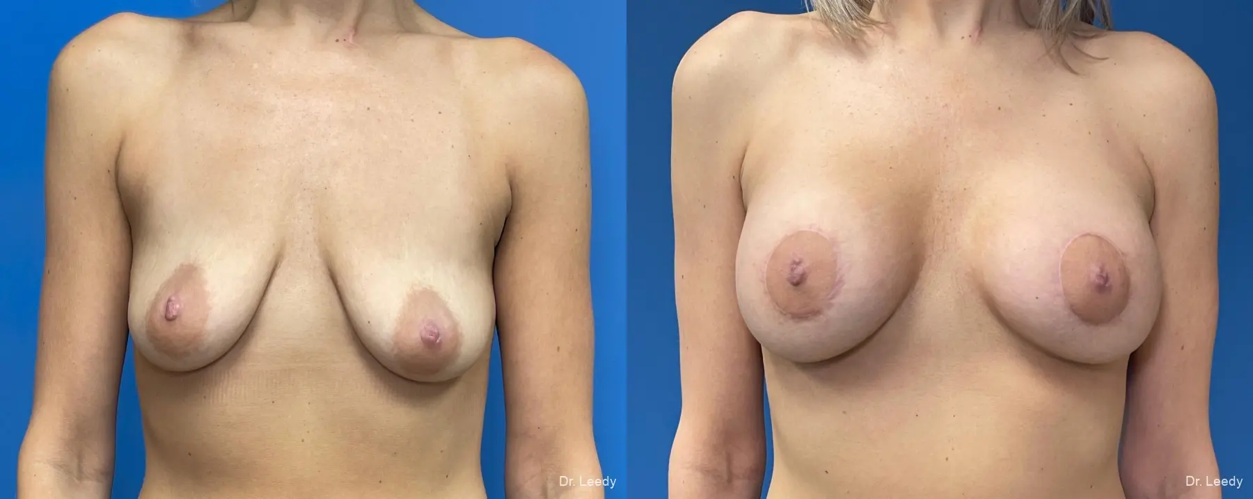 Breast Lift And Augmentation: Patient 2 - Before and After  